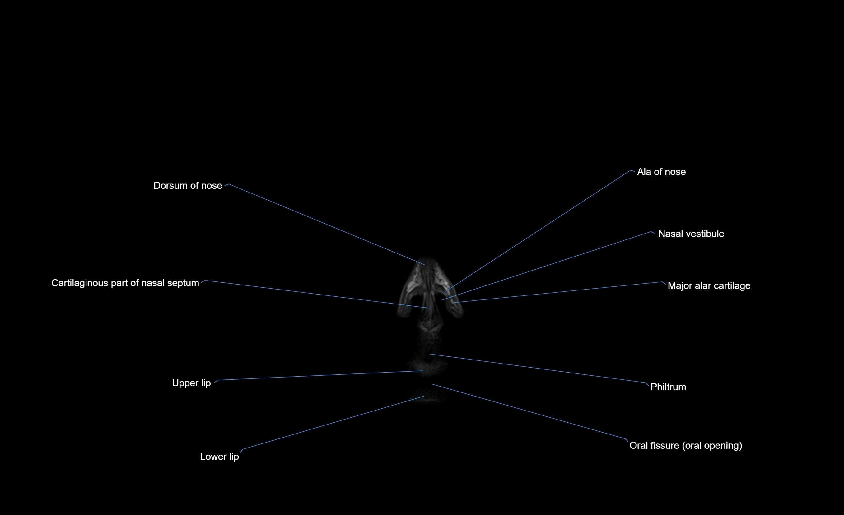 MRI face & paranasal sinuses(PNS) labelled  coronal  cross sectional anatomy 3T radiology  image-img-00001-00004.webp